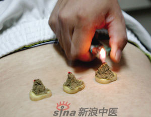 灸法的種類  你知道多少？